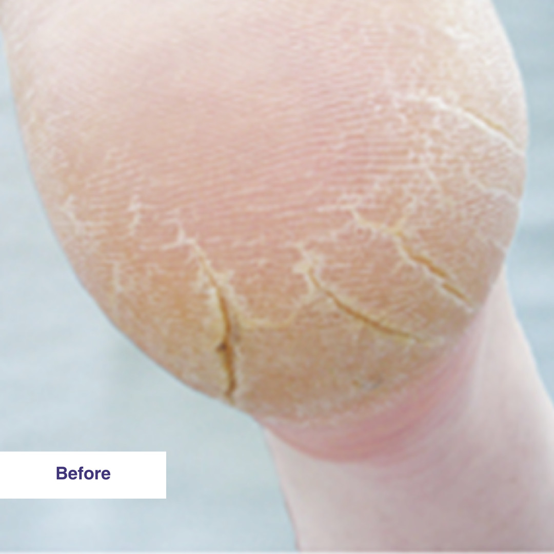 Fissures Severe Cracked Heels Causes Footlogix Cracked Heel